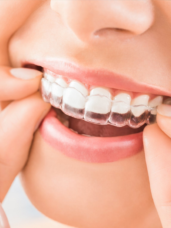 Braces Image