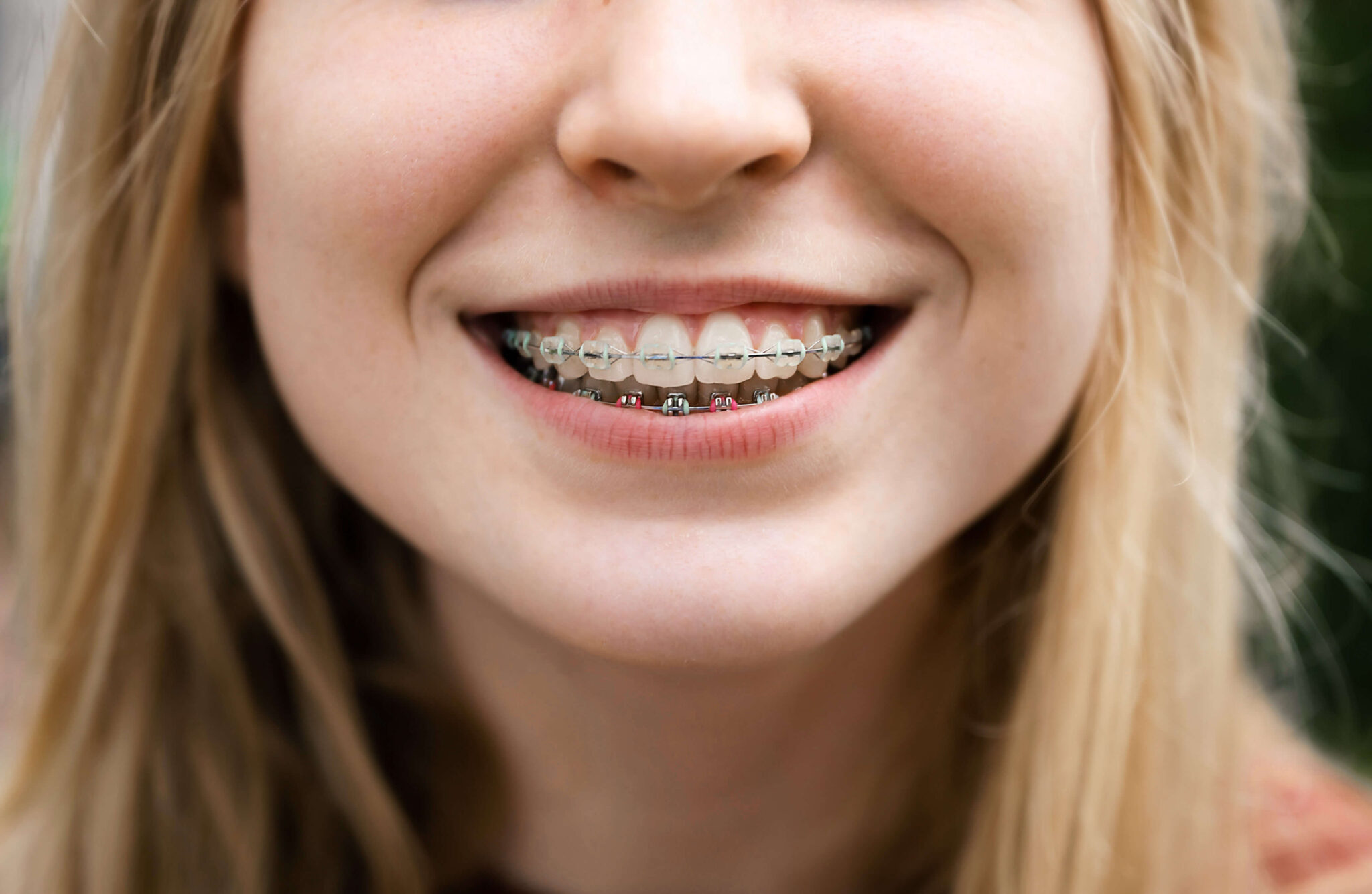Tooth Coloured And Clear Fixed Appliance