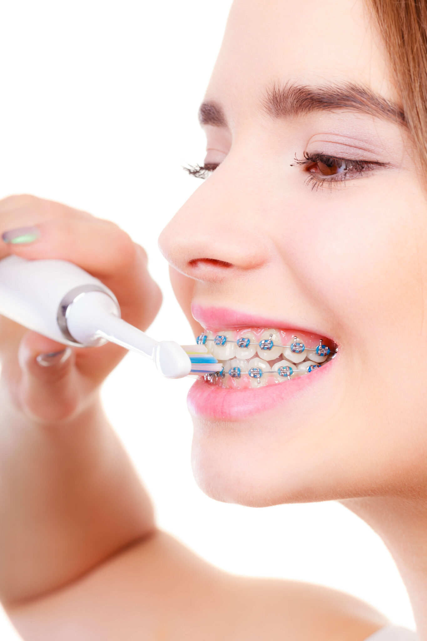 Top Tips For Looking After Your Braces